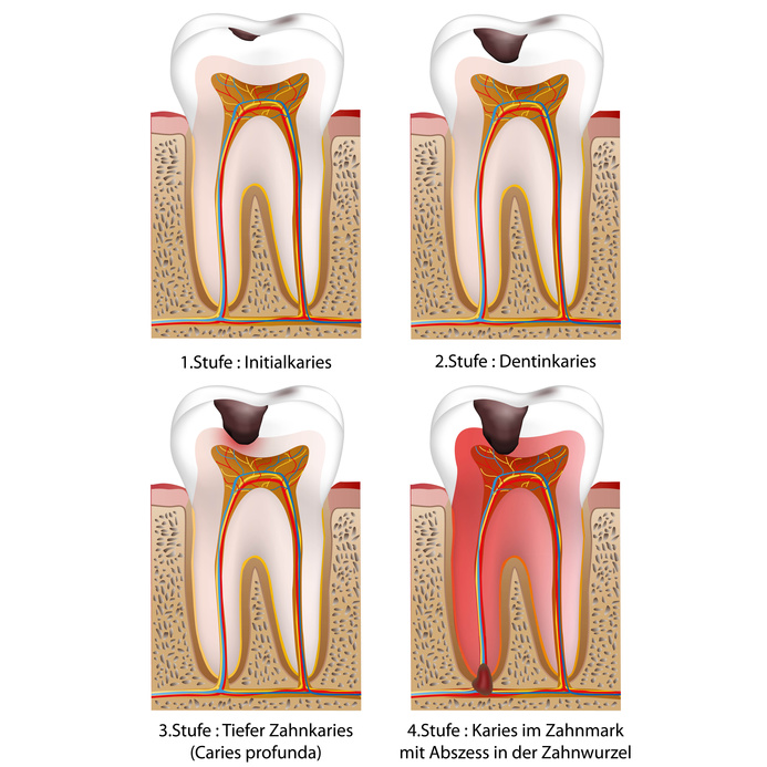 Karies in vier Stufen